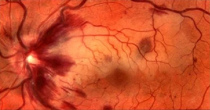 the blood vessels of the retina and the restoration of vision